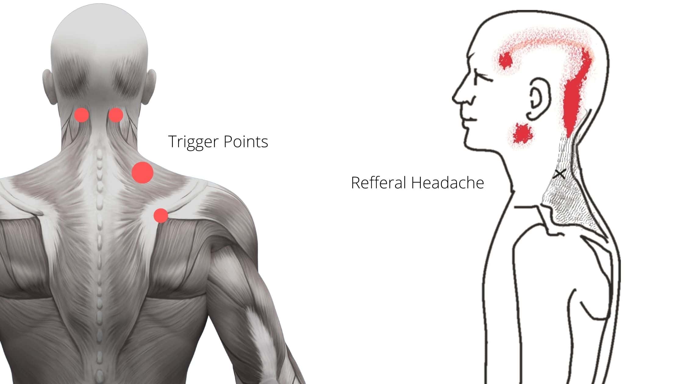 Home Exercises For Cervicogenic Headaches That Actually Work